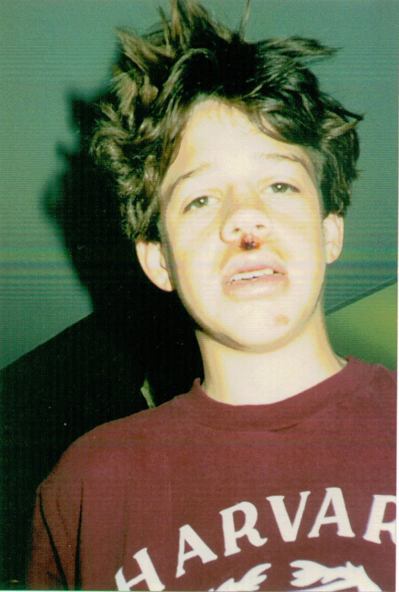 Randall Stone at age 14 after the 1988 Stanford bicycle crash